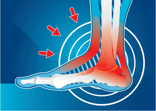 Heel Pain | Northpointe Medical