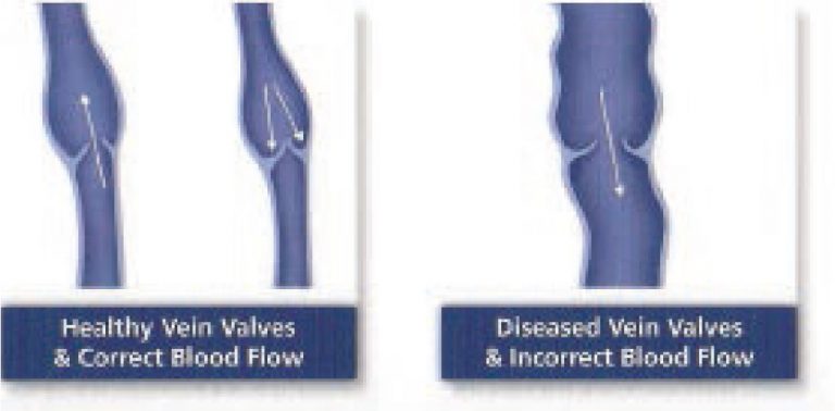 Varicose Vein Treatment | Northpointe Medical