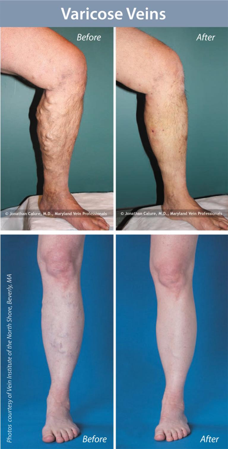 Varicose Vein Treatment Northpointe Medical