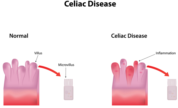 Celiac Disease | Northpointe Medical